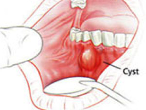 Oralna kirurgija